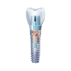 alphatech Implantatsystem: Schraubsystem