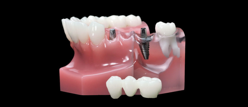 3D-Druckharze werden für Kronen und Brücken eingesetzt